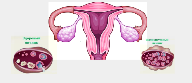Мфя в гинекологии. Поликистоз яичников и мультифолликулярные яичники. Мультифолликулярный поликистоз. Поликистоз мультифолликулярных яичников. Мультифолликулярные яичники и СПКЯ.