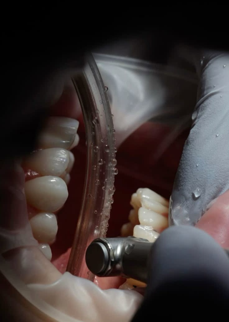 Dental Fillings and Restoration