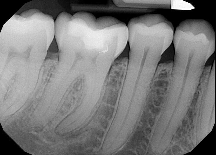 Root Canal Treatment