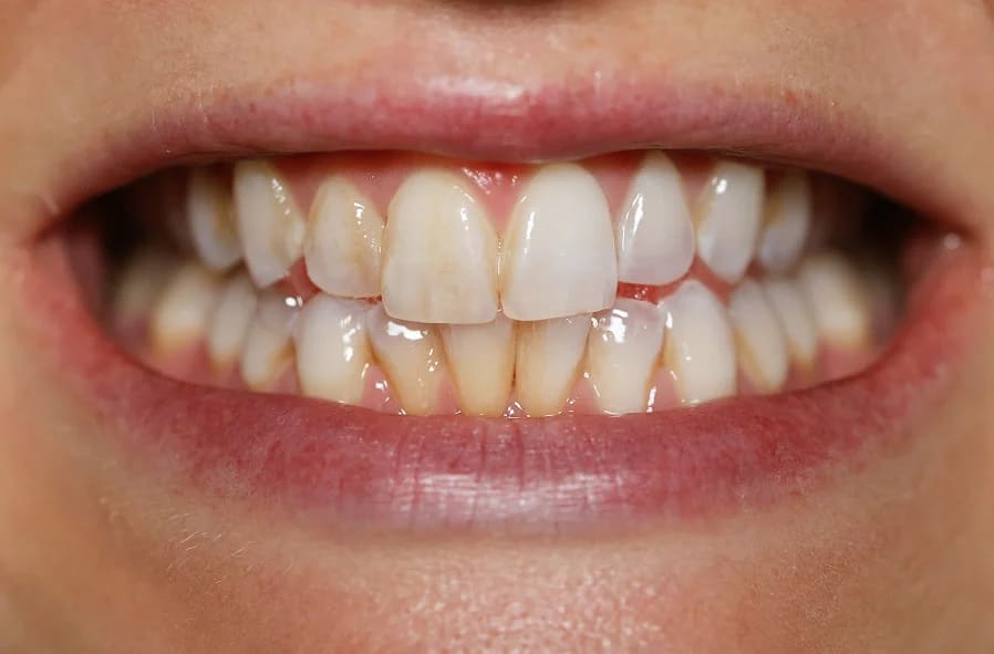 Before treatment - 60-Min Whitening