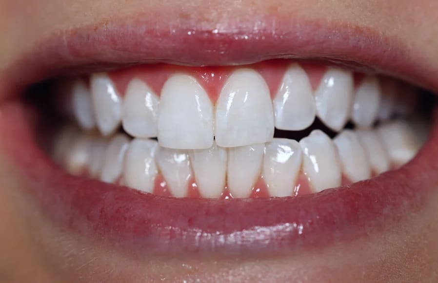 After treatment - 60-Min Whitening