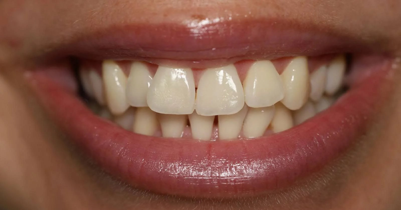 Before treatment - 60-Min Cleaning & Whitening