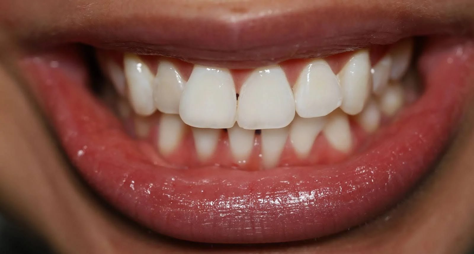 After treatment - 60-Min Cleaning & Whitening