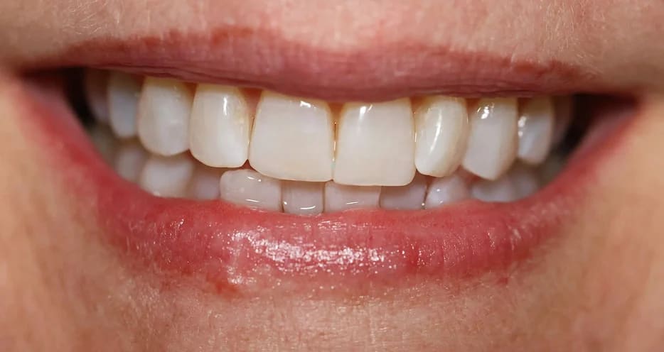 After treatment - 60-Min Whitening