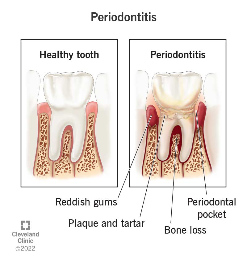 Gum Disease