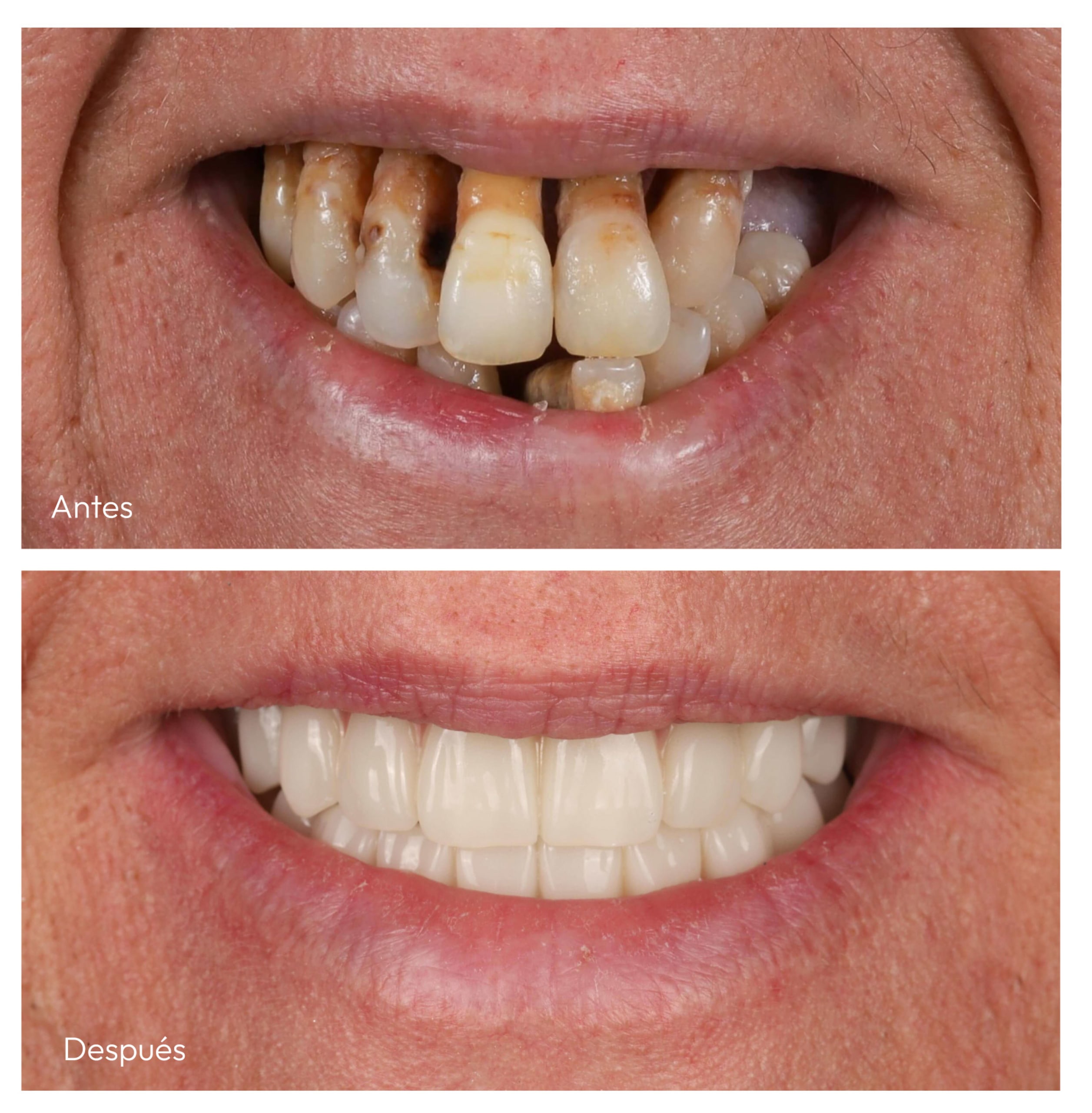 Antes y después de rehabilitación completa con implantes dentales
