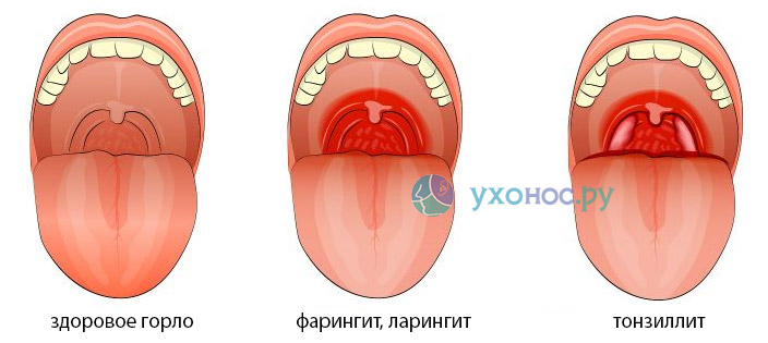 Здоровое горло фото внутри как выглядит Гемолитический стрептококк в горле