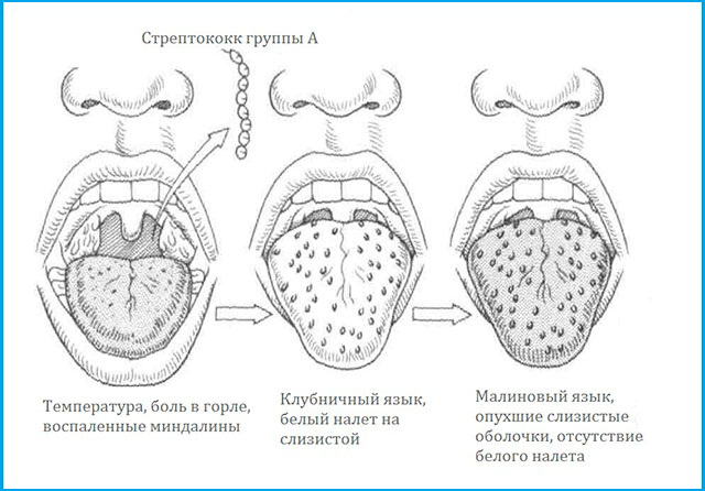 Как выглядит горло при кори