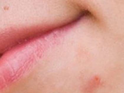 Роспотребнадзора по РТ напомнил о профилактике энтеровирусной инфекции