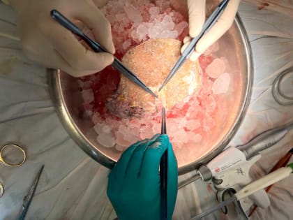 «Печень с паразитами оперировали отдельно от пациента»: в РКБ провели редкую операцию