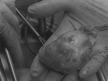 Медики БСМП Челнов удалили огромную опухоль из сердца пациента