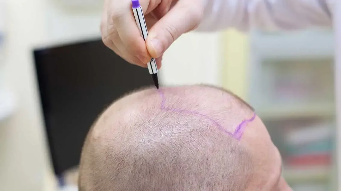 Hair-Transplantation.webp