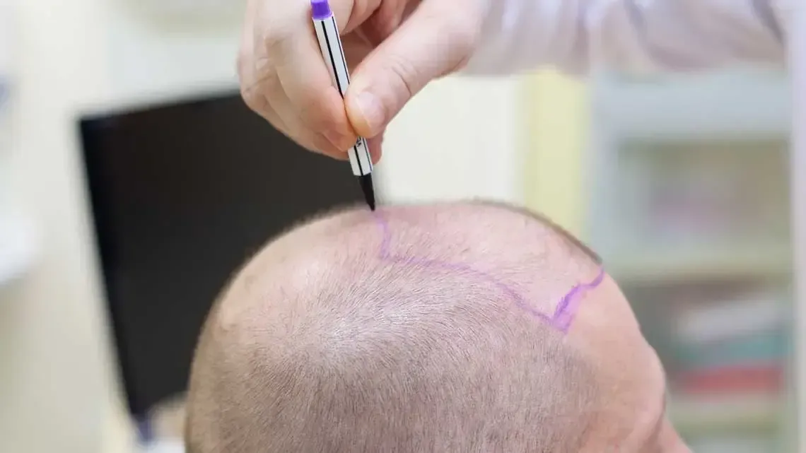 Hair_Transplantation_70afc84c2b.webp