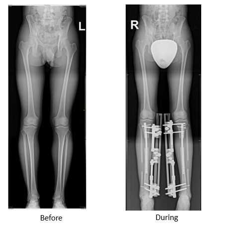 What are the Lengthening Methods, and How Are They Selected?