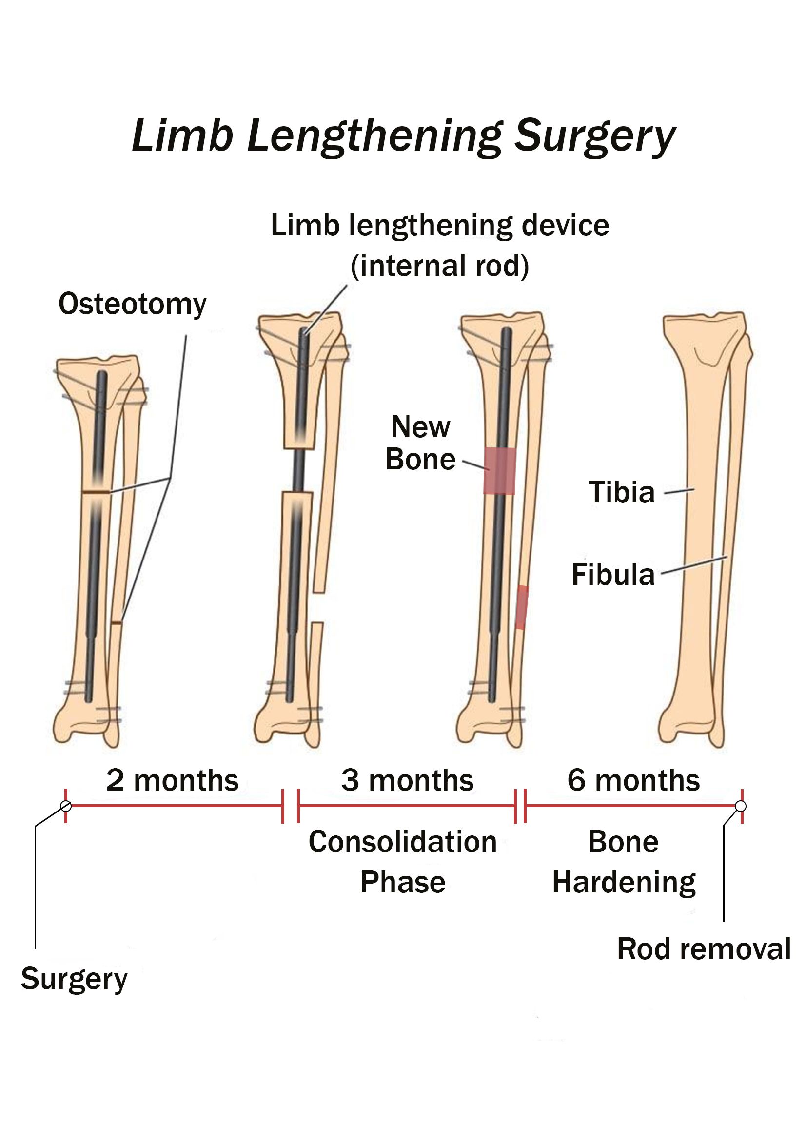 Length_Surgery_1.jpg