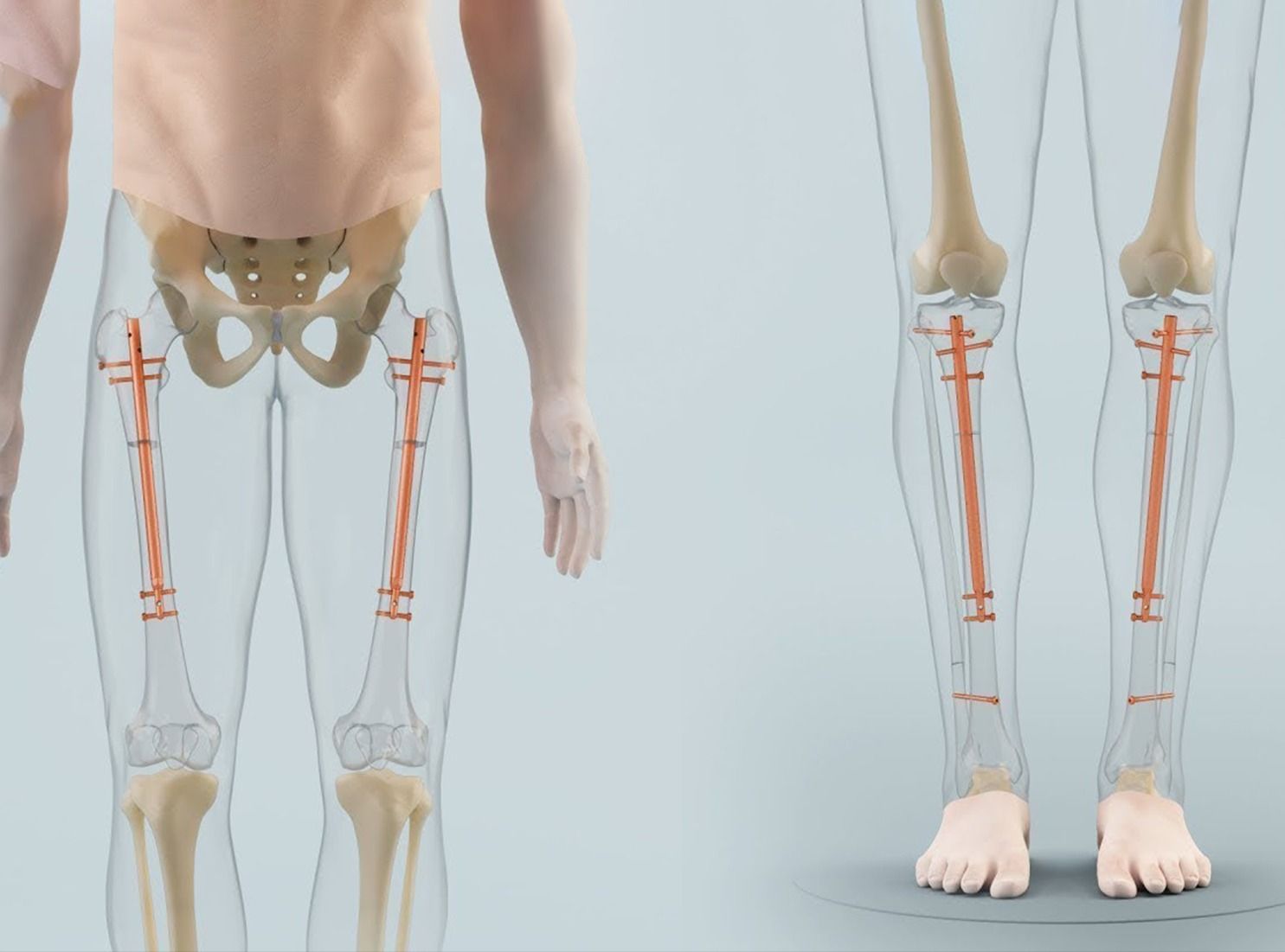 Limb Lengthening Surgery Age Limit