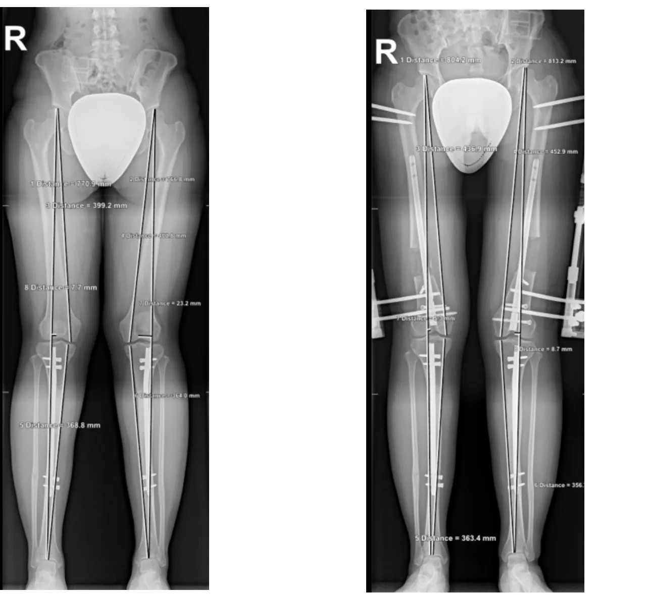 Want To Be Taller With Limb Lengthening Surgery