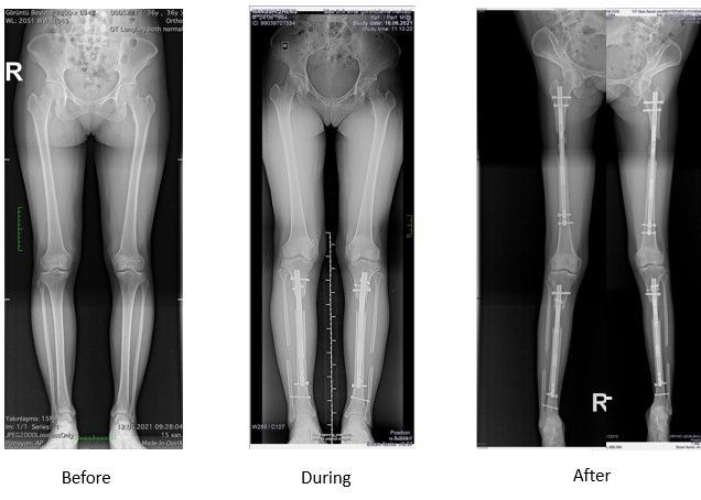 How Many Inches Can I Grove with Limb Lengthening Surgery?