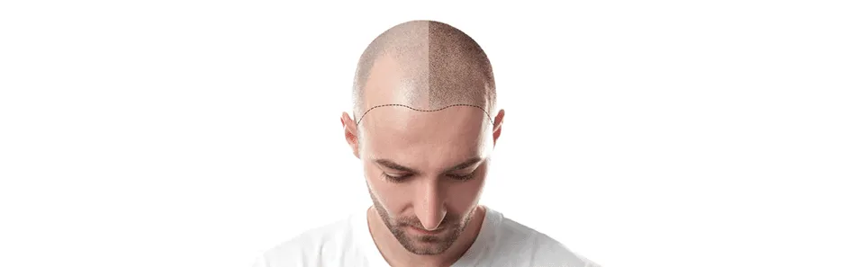 Hair Transplantation