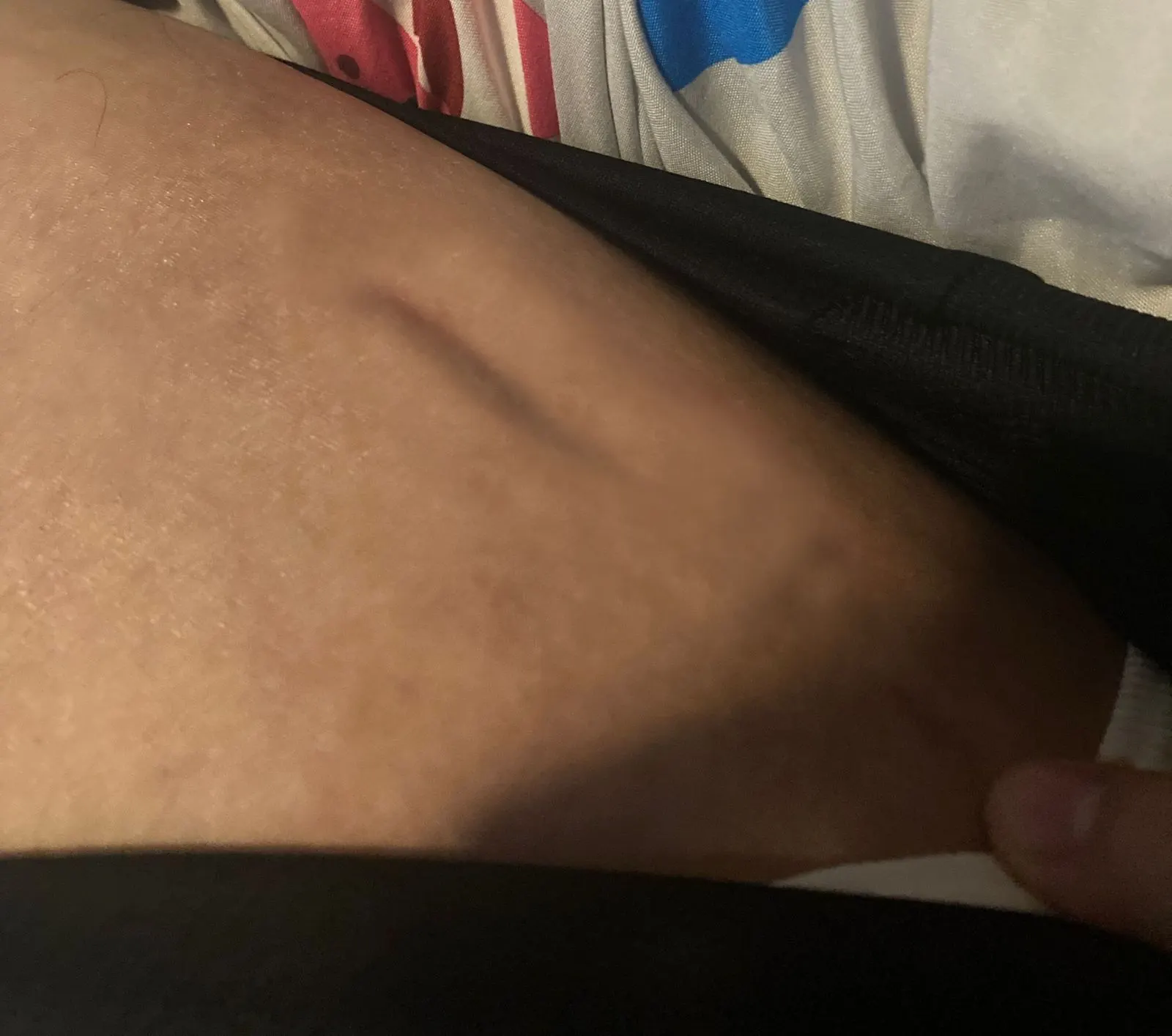 LON SCARS POST 1 YEARS FROM REMOVAL