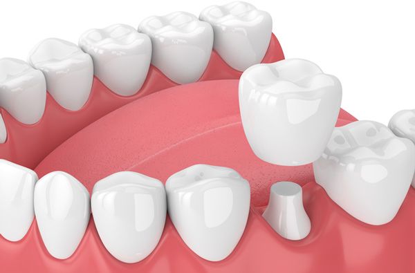 How Long Does a Dental Crown Last?