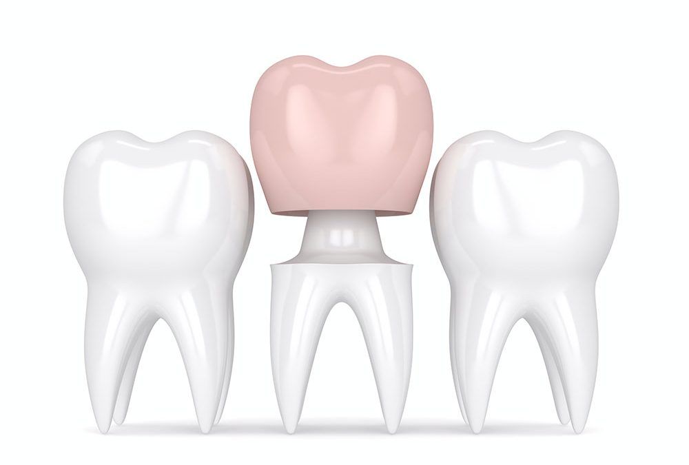 four-benefits-of-dental-crowns-toronto-dentist-1000x675.jpg