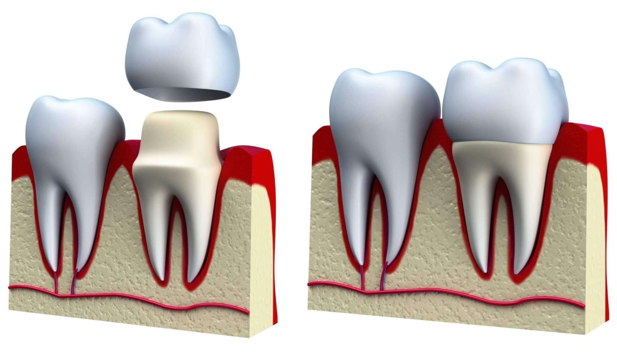 dental-crown-1-scaled-1.jpg
