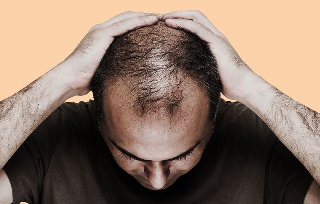 What Vitamin Deficiency Causes Hair Loss?