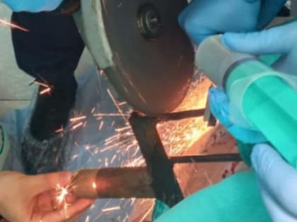 Спасатели помогли хирургам вытащить вилы из головы пациента