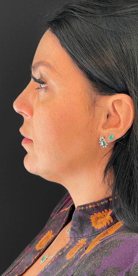 Mulher de perfil, antes do procedimento, em fundo escuro