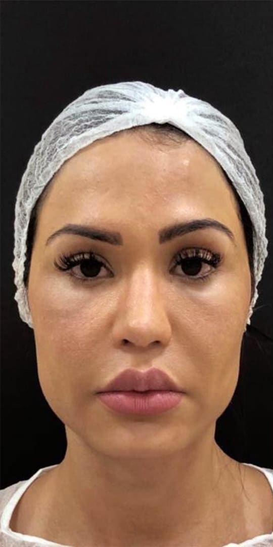 Mulher de frente, antes do procedimento, com touca cirúrgica e sem maquiagem