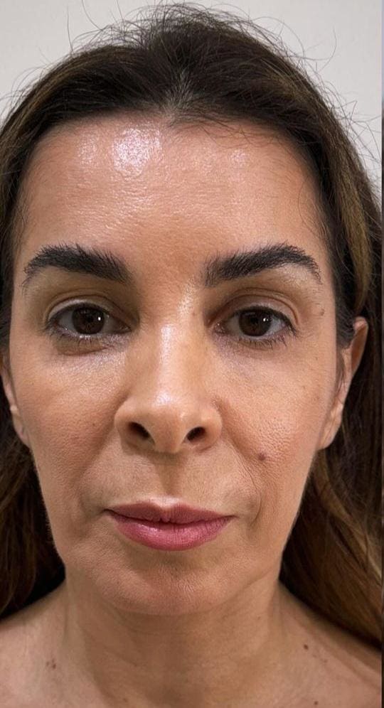 Mulher de frente, antes do procedimento, em registro clínico sem maquiagem