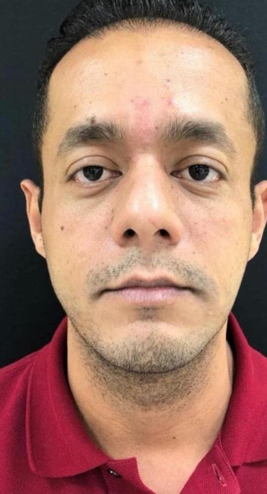Homem de frente, antes do procedimento, em fundo escuro e luz frontal uniforme