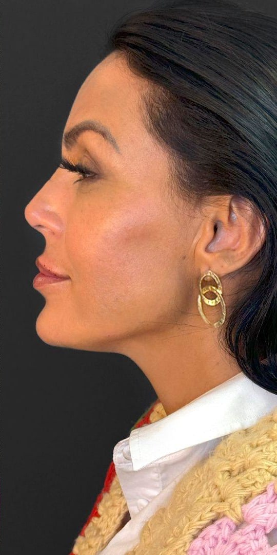A mesma mulher de perfil, depois do procedimento, no mesmo fundo escuro
