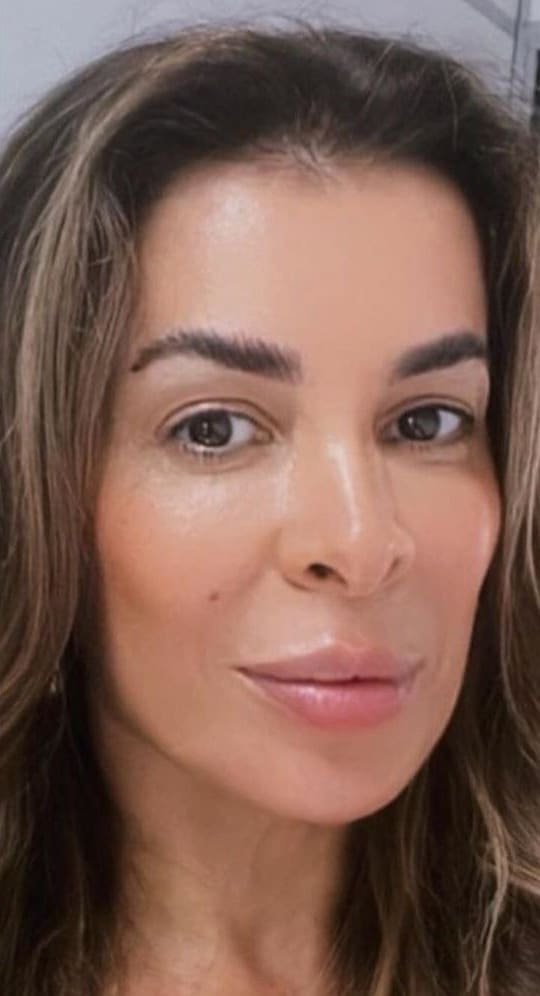 A mesma mulher de frente, depois do procedimento, em selfie