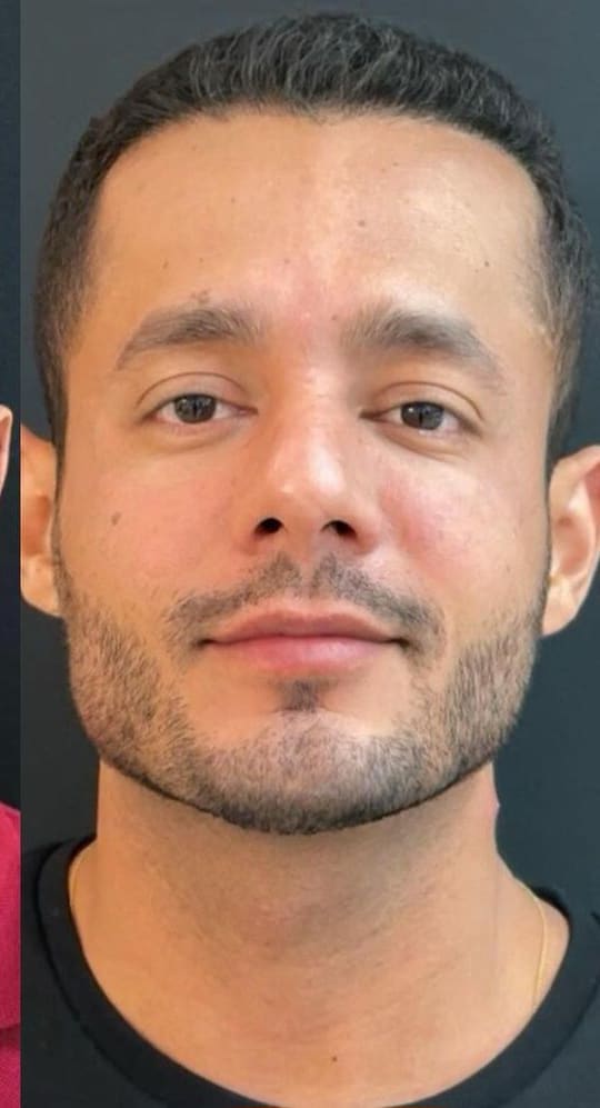 O mesmo homem de frente, depois do procedimento, no mesmo fundo escuro e mesma luz