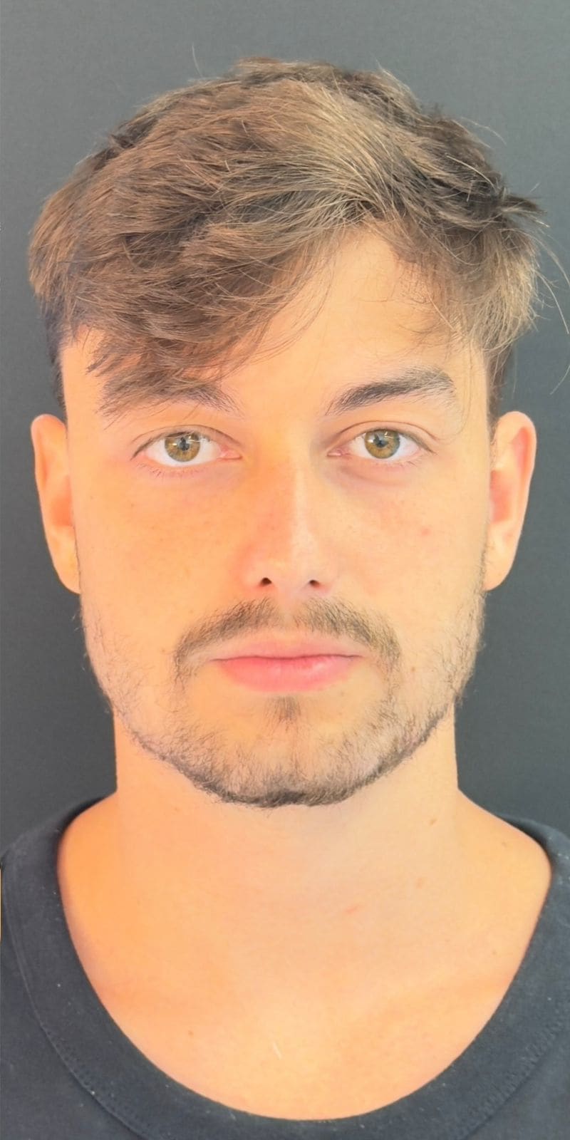 O mesmo homem de frente, depois do procedimento, no mesmo fundo cinza