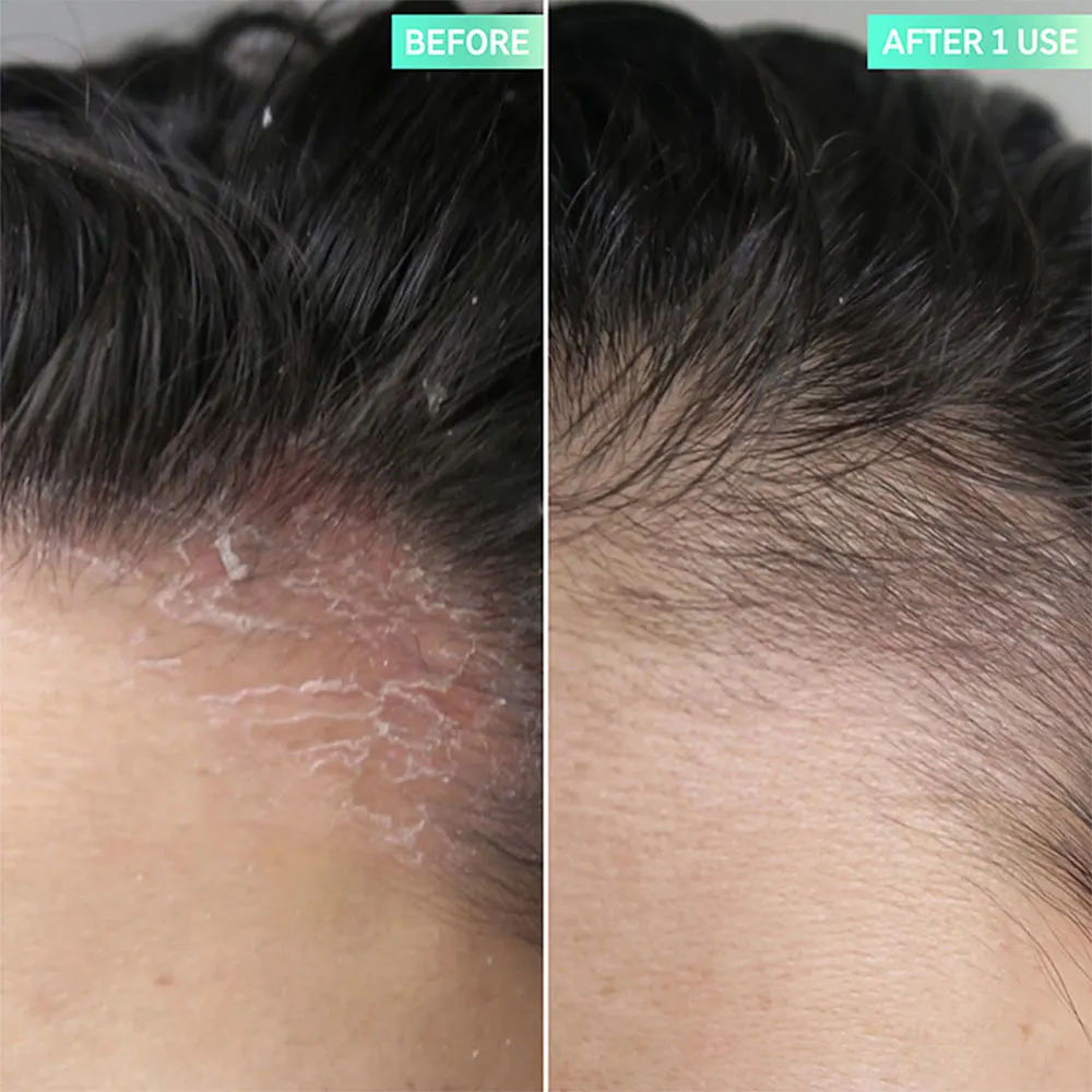 Salicylic Acid Exfoliating Scalp Treatment