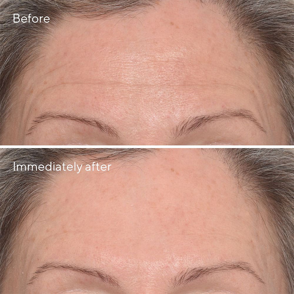 Targeted Wrinkle Corrector