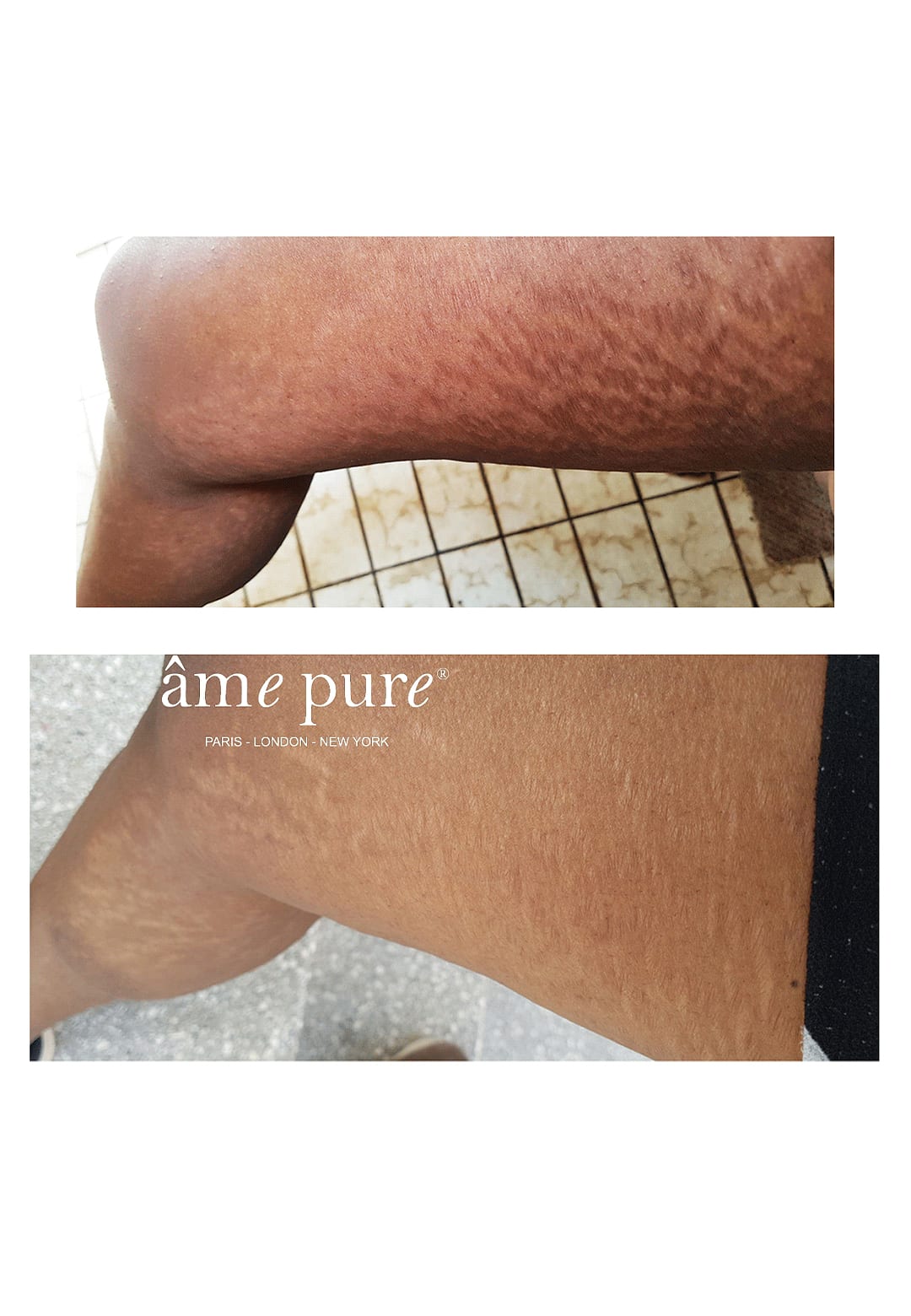 Âme Pure® Body Basic Stretch Marks Kit