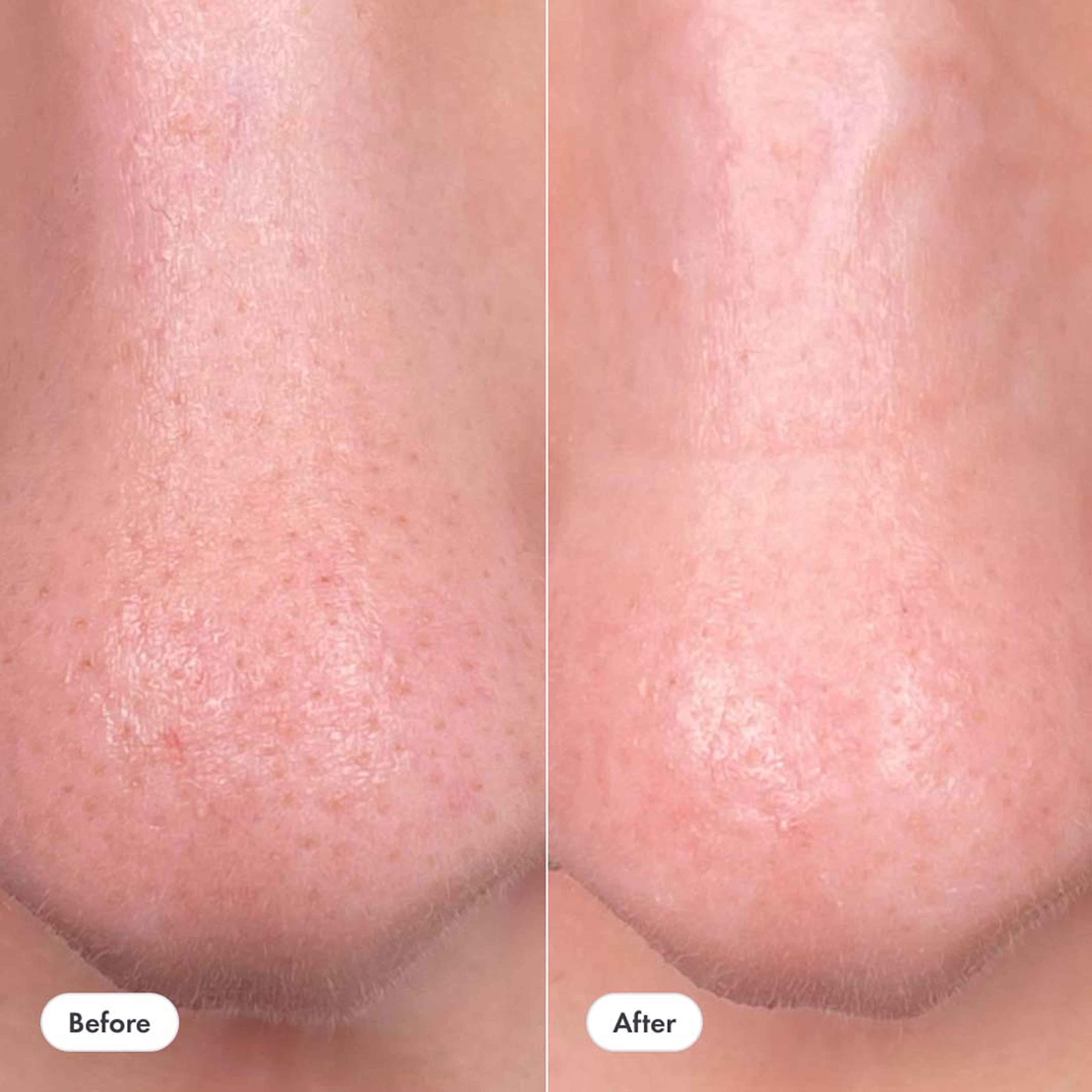 Nose Patch, från HERO. Klicka för att öppna bilden i stort format