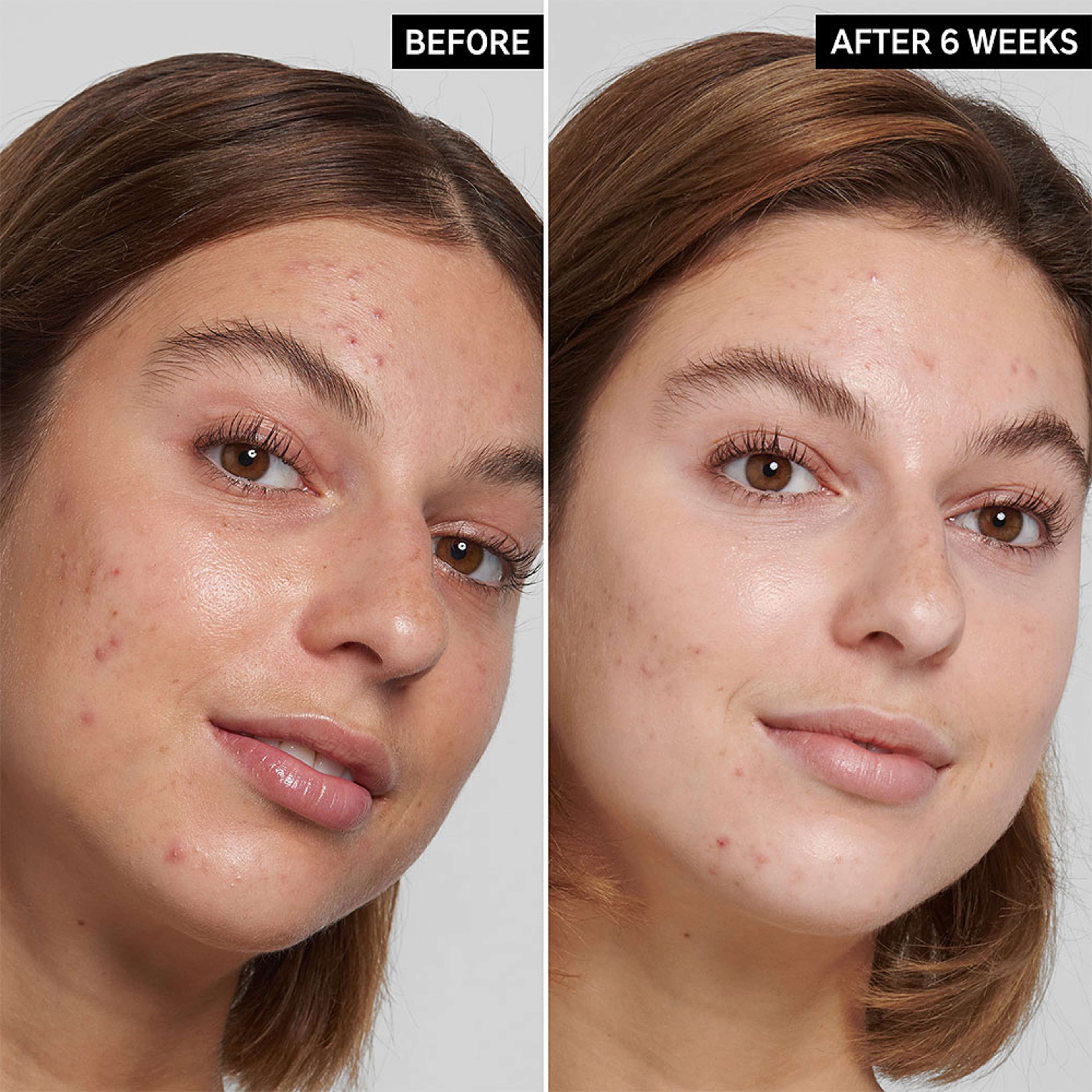 Salicylic Acid Cleanser