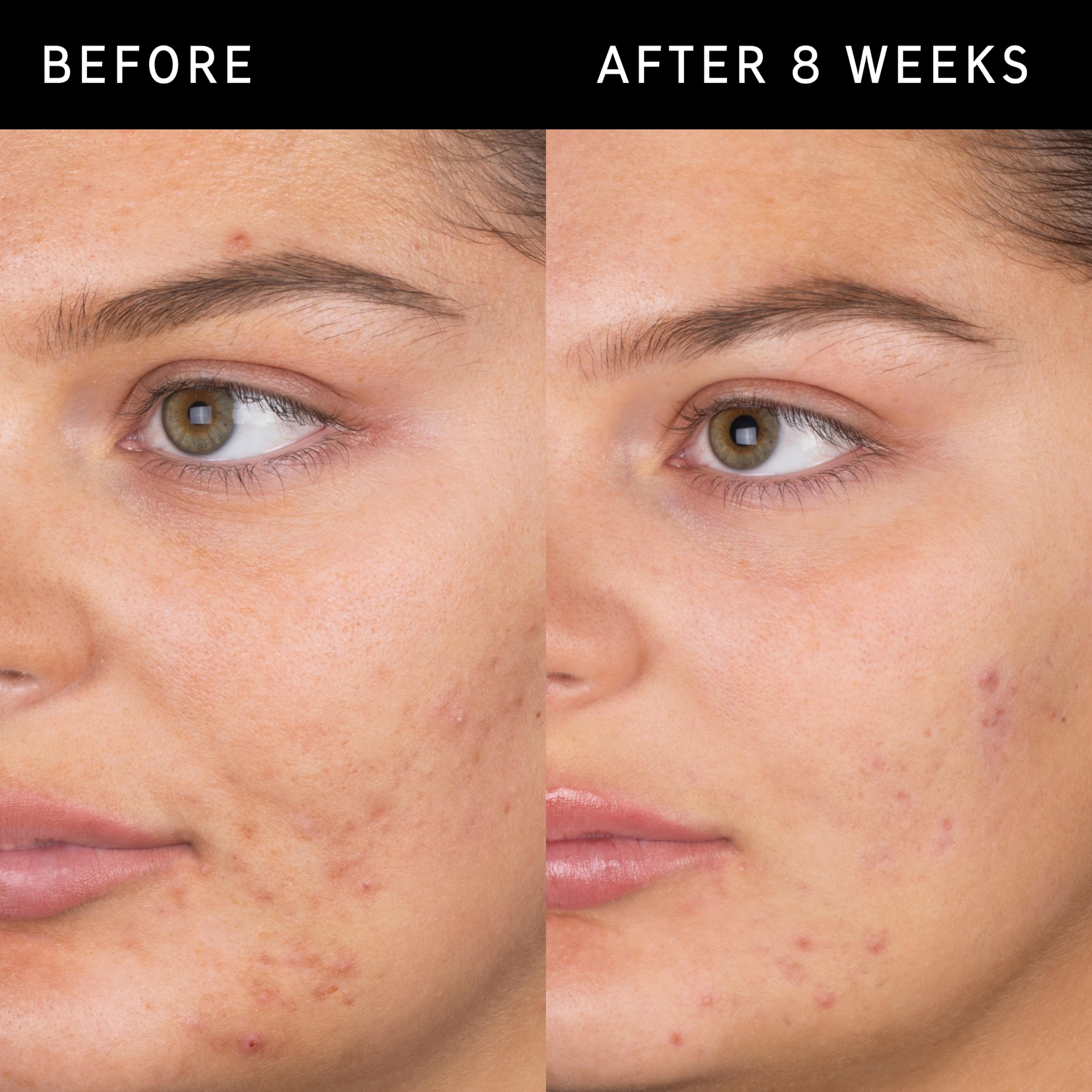 Salicylic Acid Cleanser