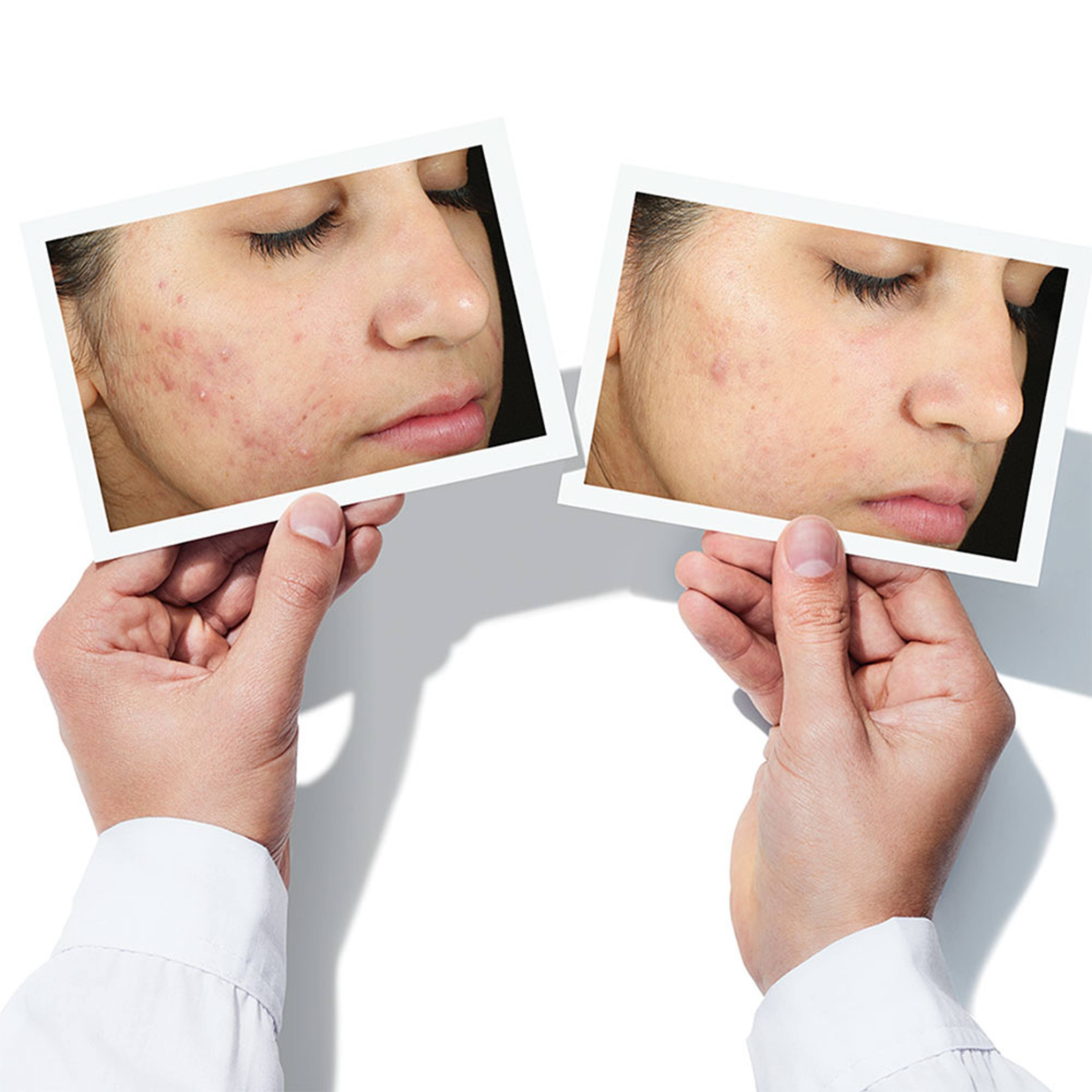 Invisiscar Resurfacing Treatment