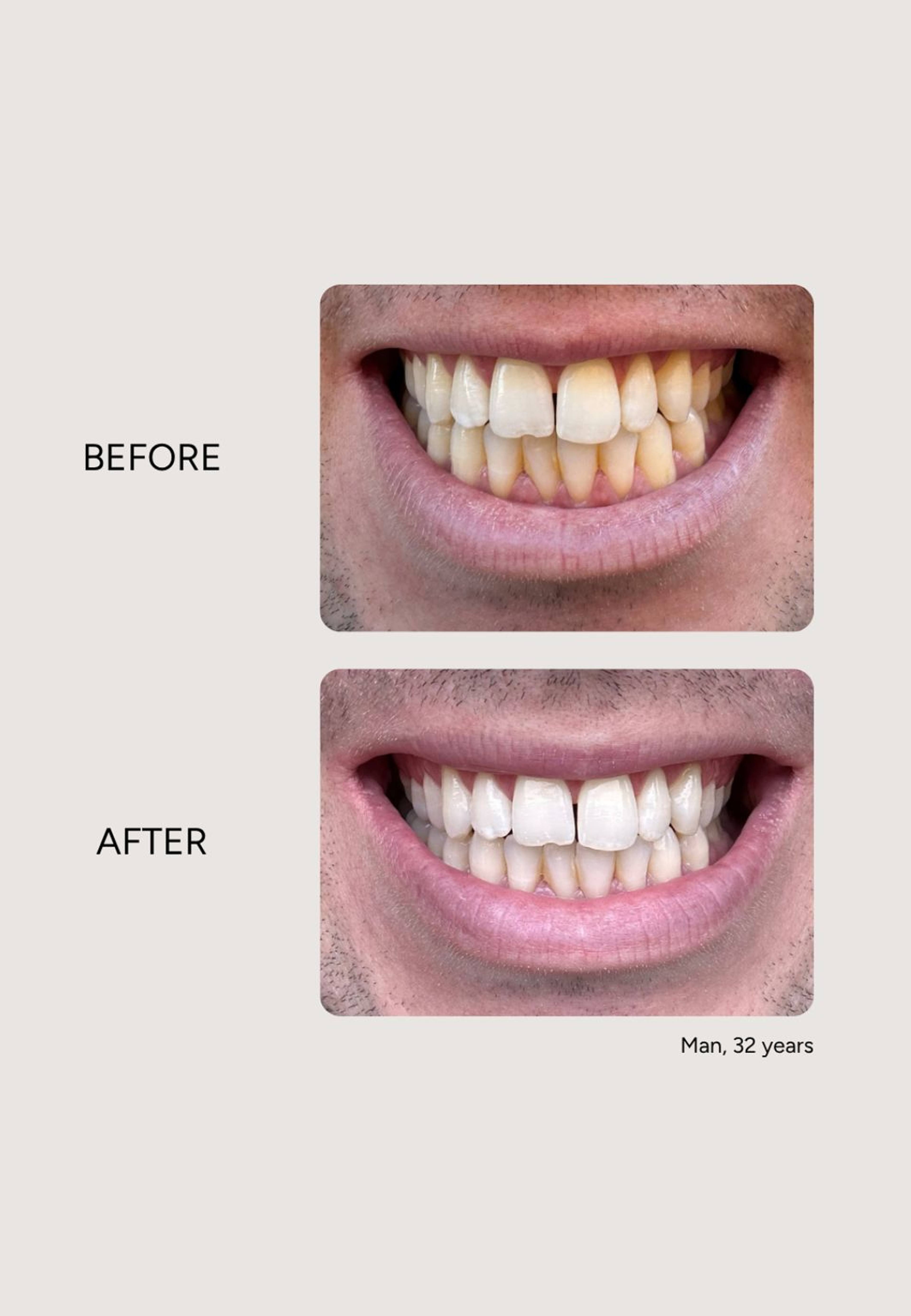 Essential Whitening & Remineralizing Kit, från Etinour. Klicka för att öppna bilden i stort format