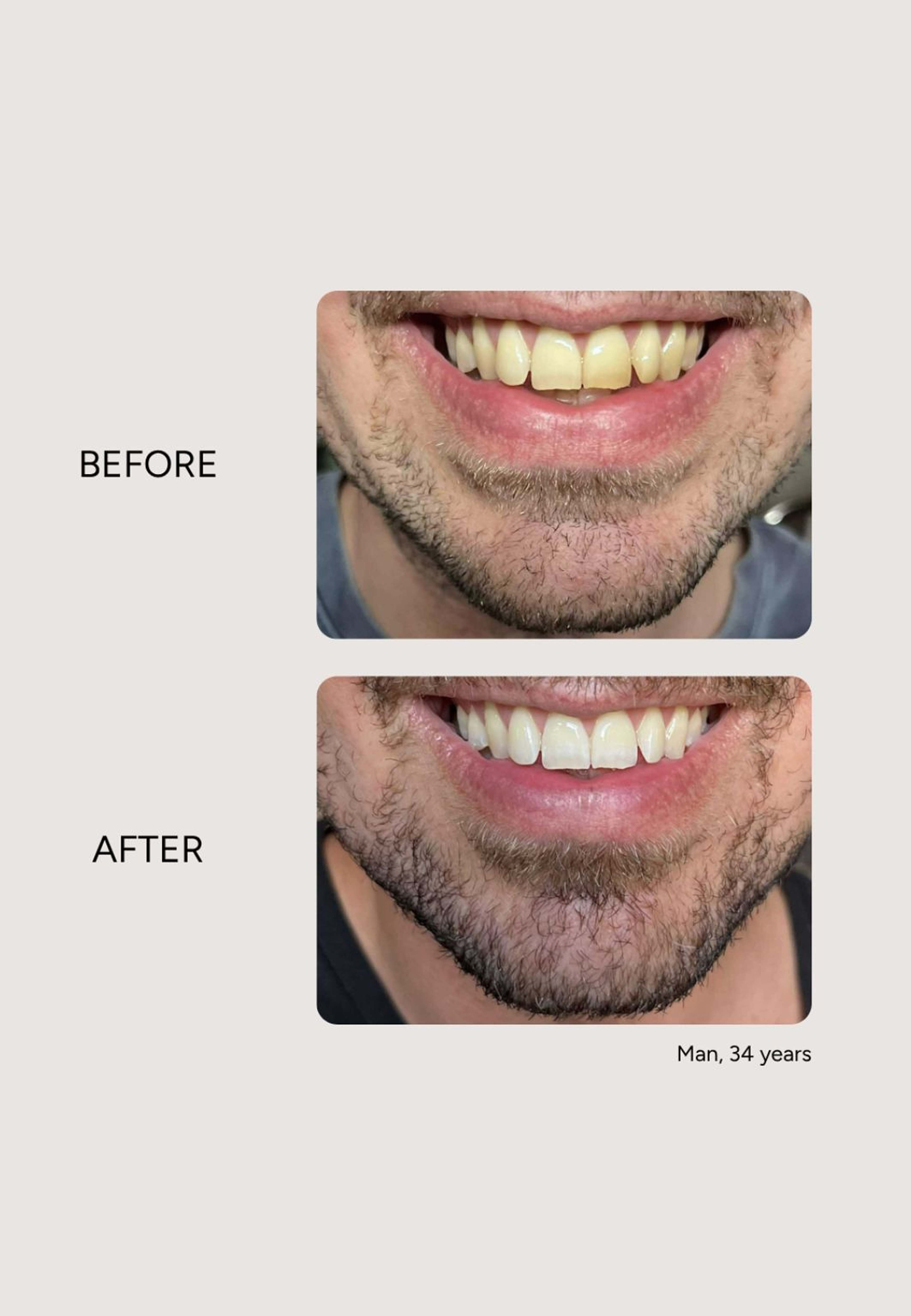 Essential Whitening & Remineralizing Kit, från Etinour. Klicka för att öppna bilden i stort format