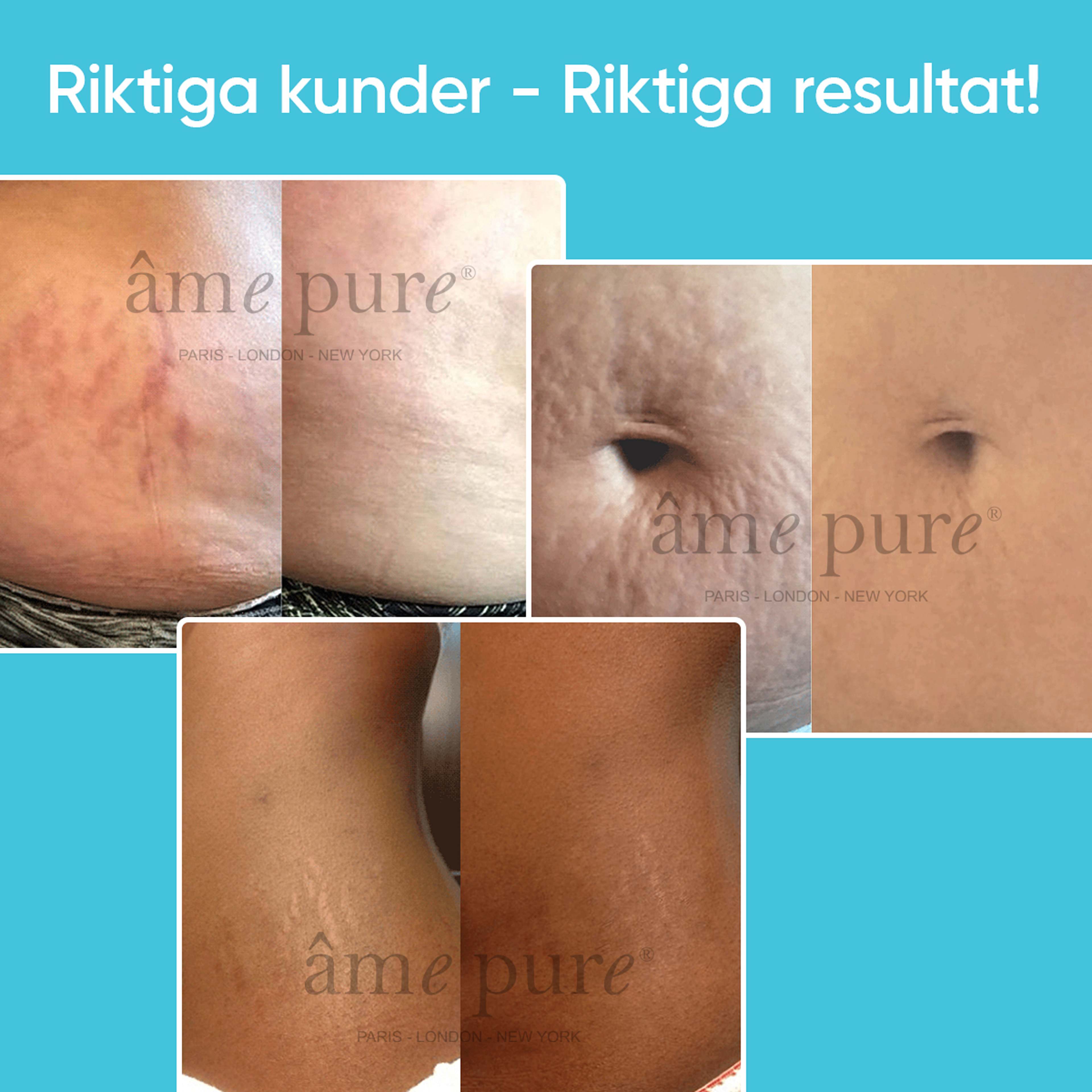 Âme Pure® Body Basic Stretch Marks Kit