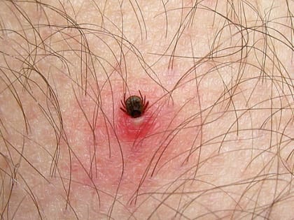 С начала лета в регионе от укусов опасными паразитами пострадали более двух сотен человек