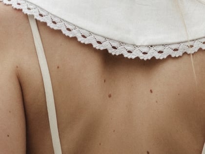 900 жителей Калужской области проверили родинки с помощью чат-бота