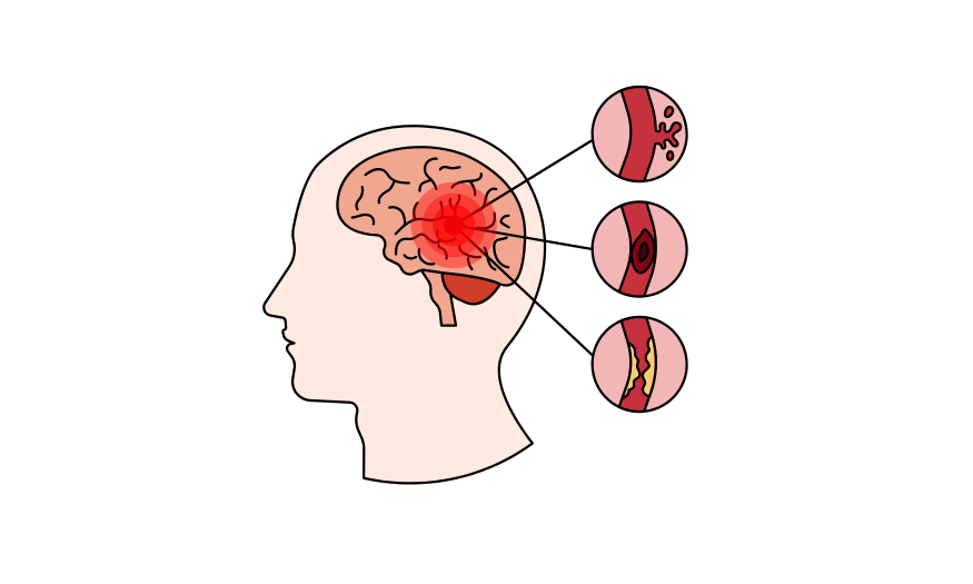 Stroke Management